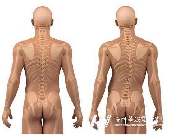 深圳少儿模特形体矫正机构-孩子驼背怎么办(图1) 图片