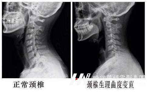 深圳少儿模特形体矫正机构-孩子驼背怎么办(图3) 图片